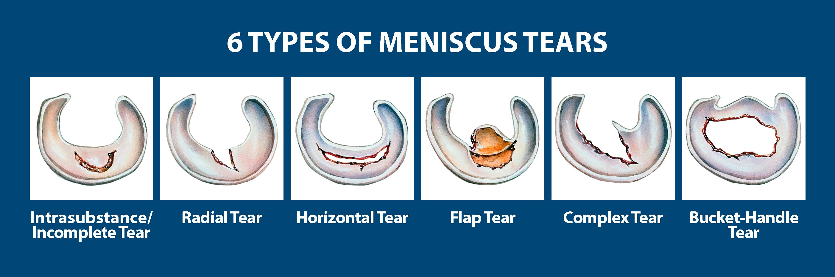 Different Types Of Meniscus Tears