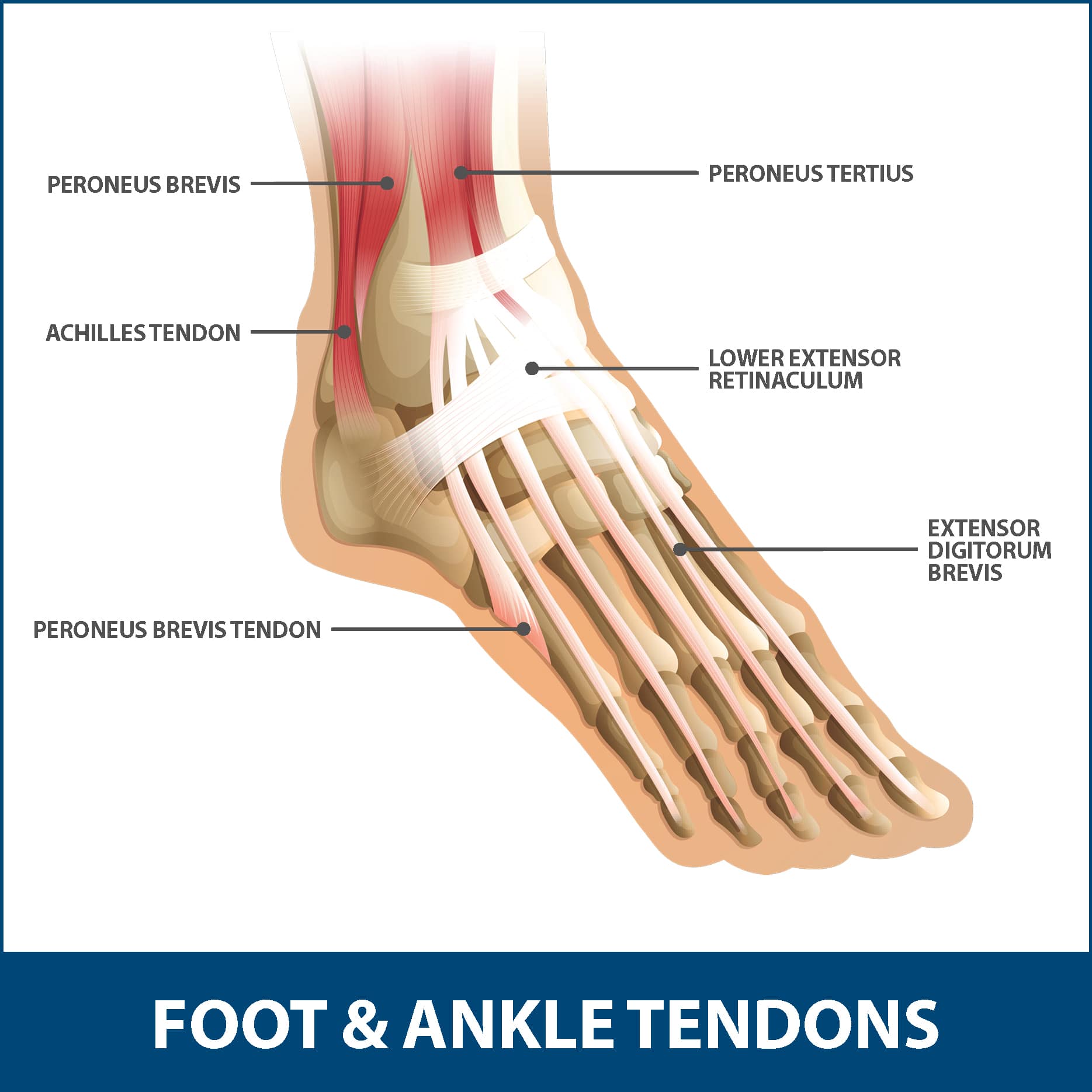 Achilles Tendon Pain: Causes, Symptoms and Treatment