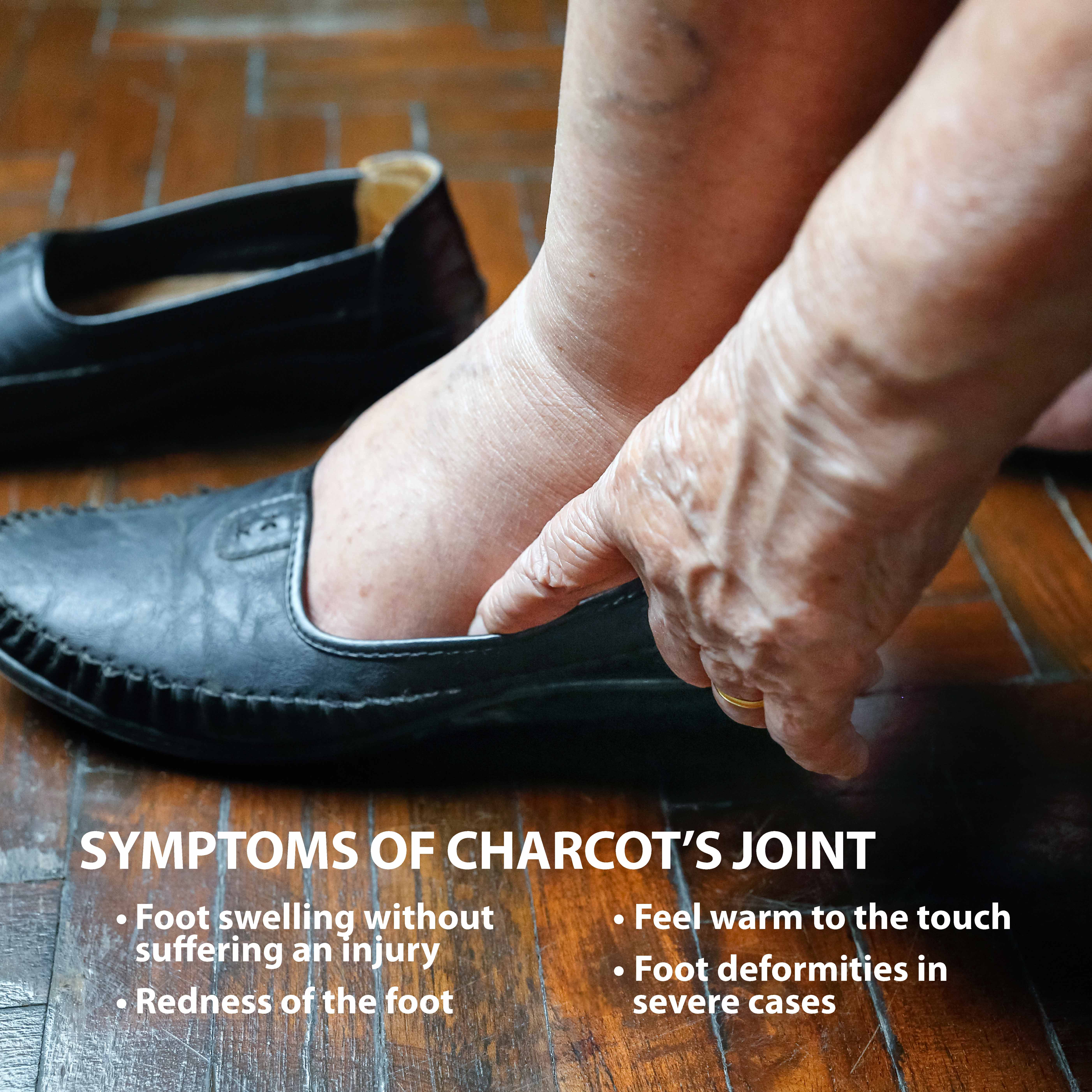 Charcot Joint Information Florida Orthopaedic Institute