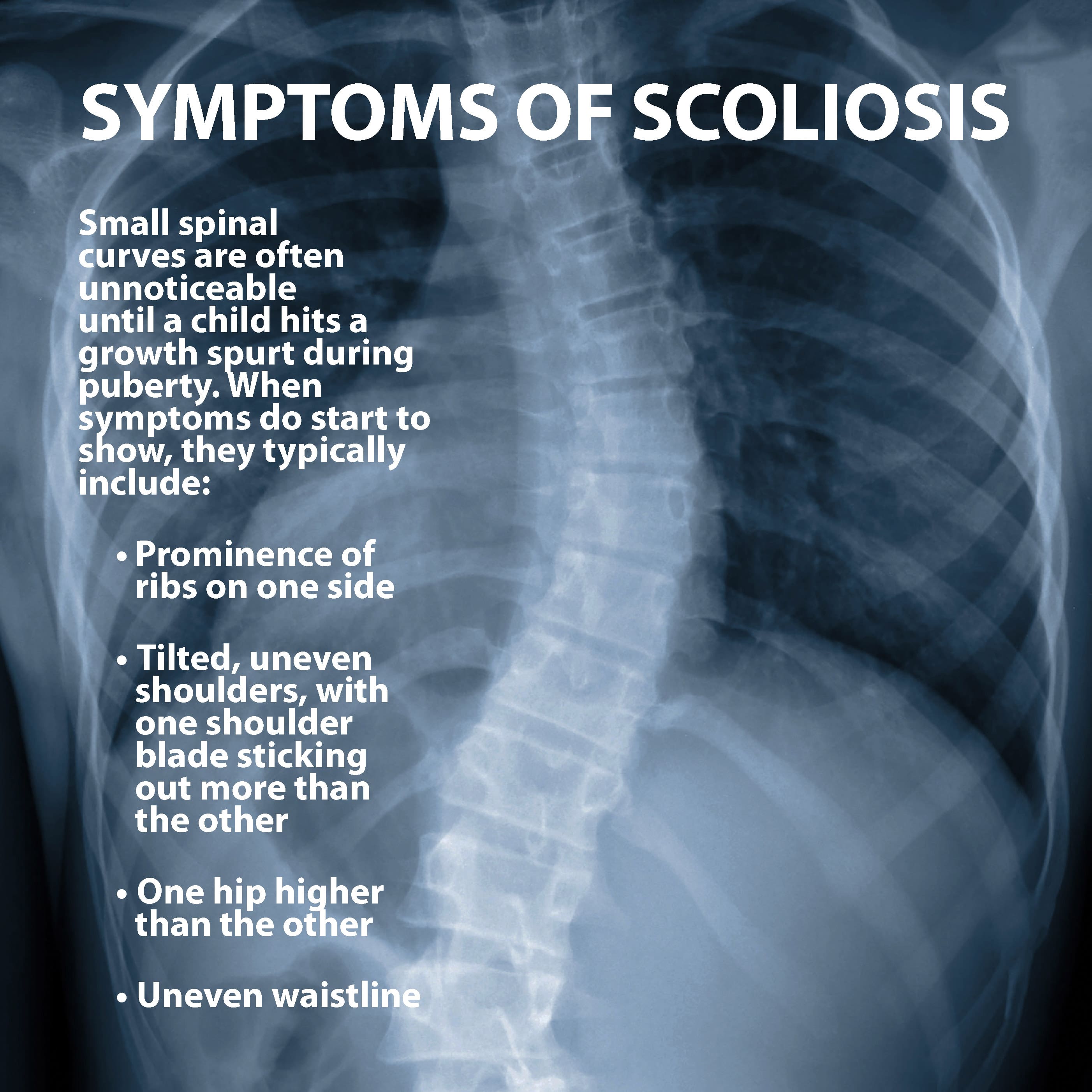 What medical conditions cause scoliosis?