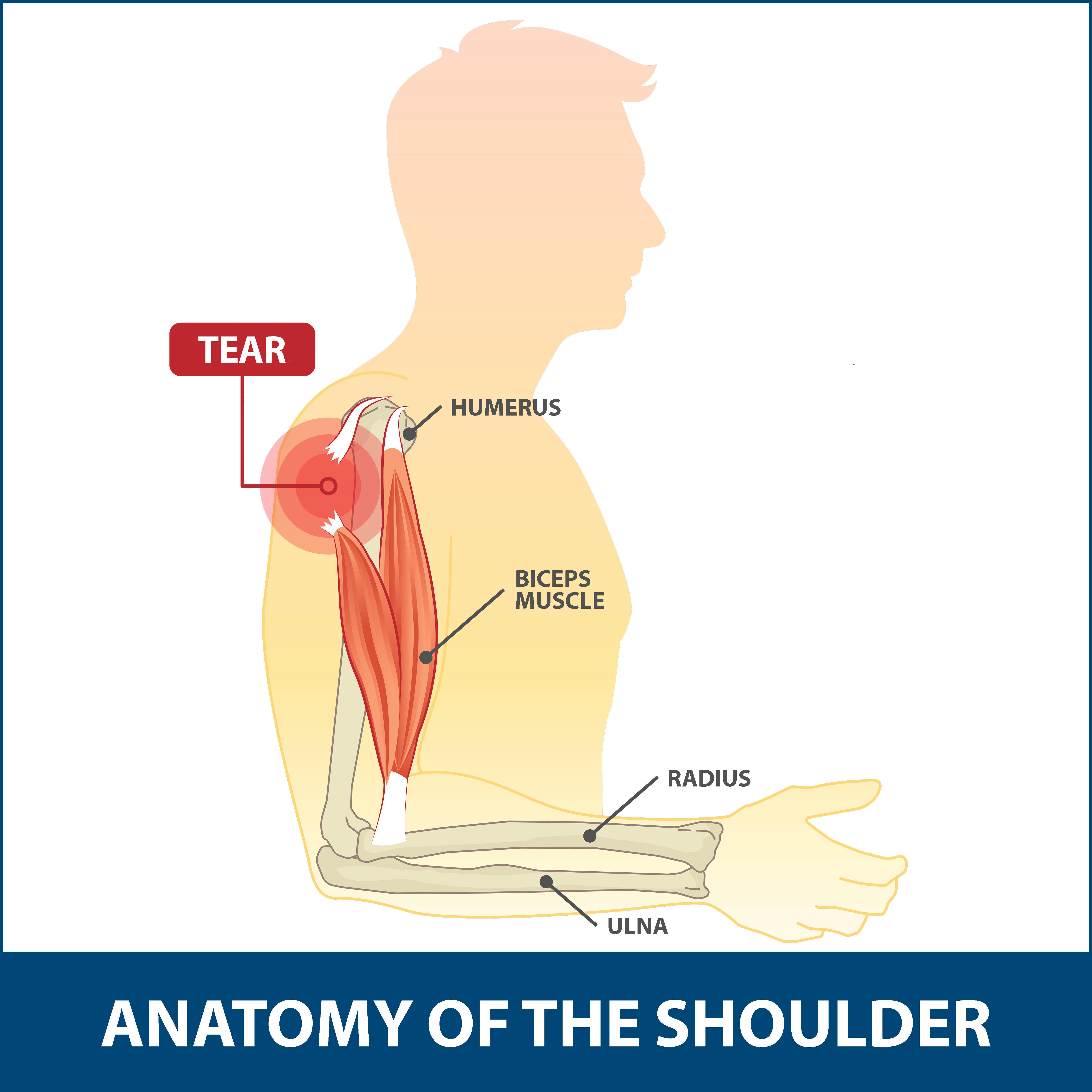 shoulder tendon injury