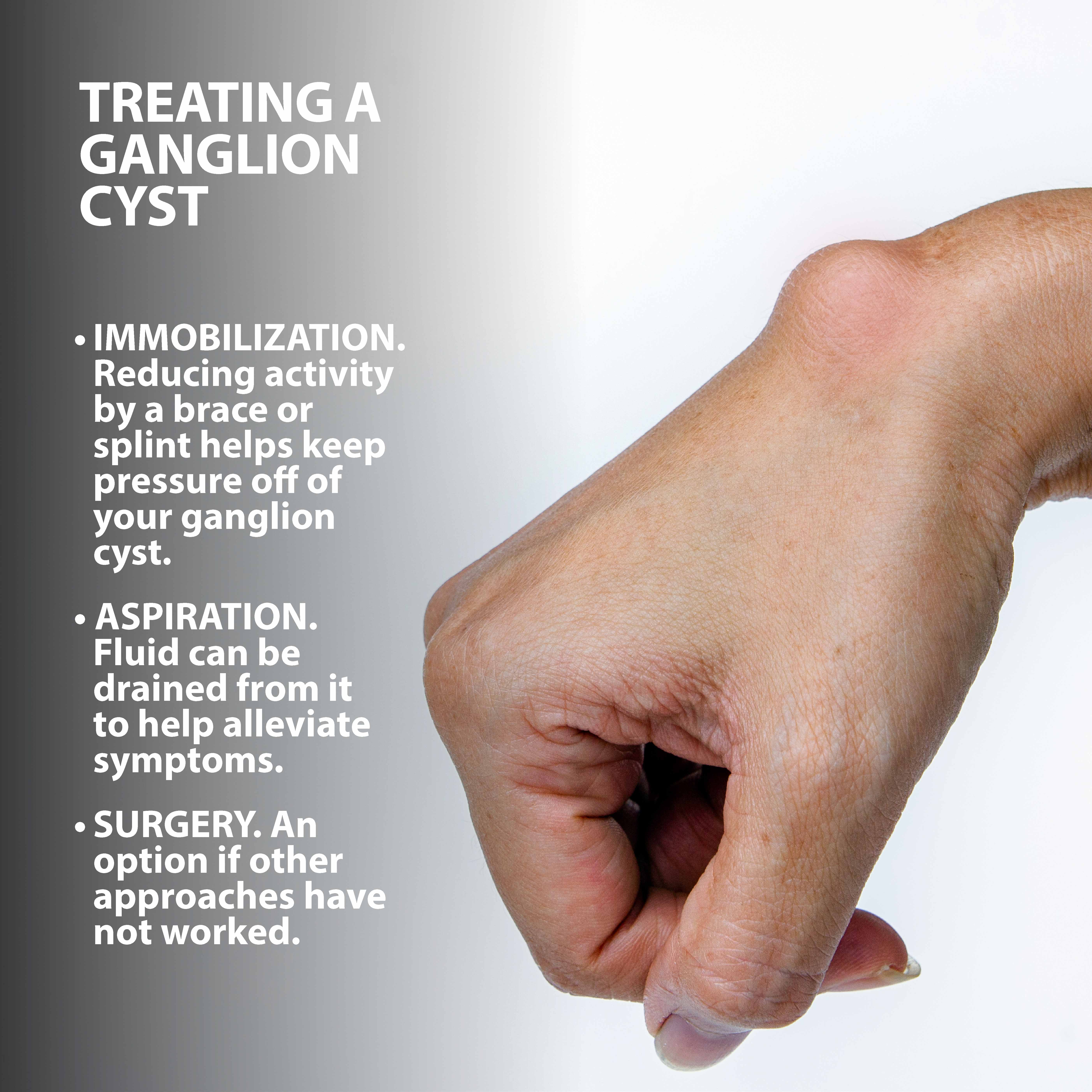Ganglion Cyst Symptoms Causes And Treatment Sexiz Pix