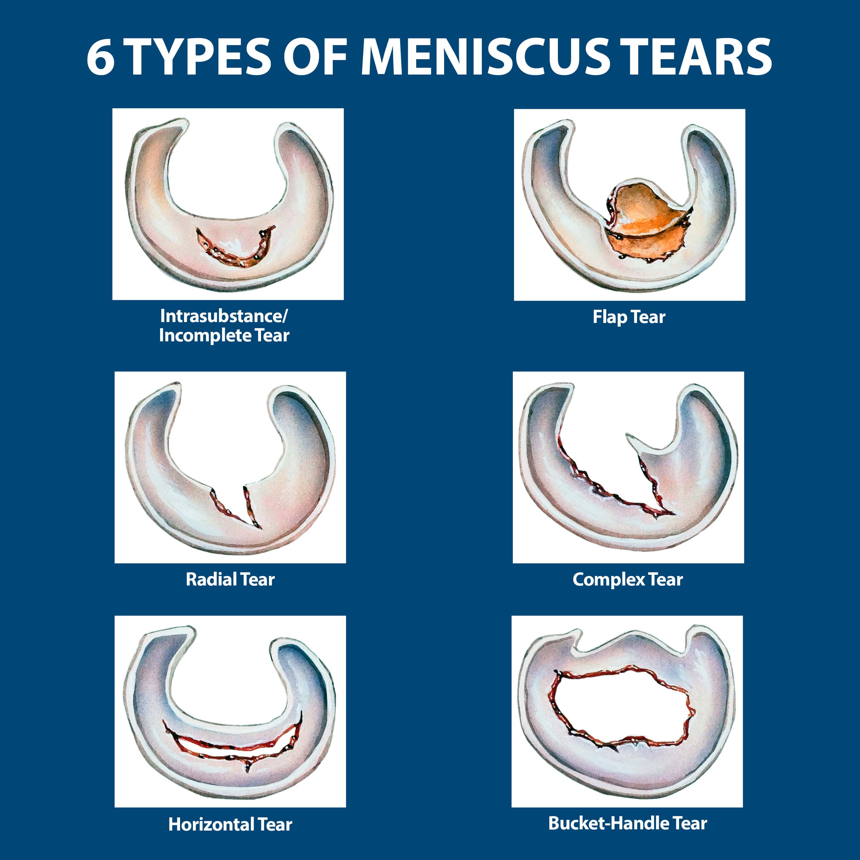 Meniscal Tear Types