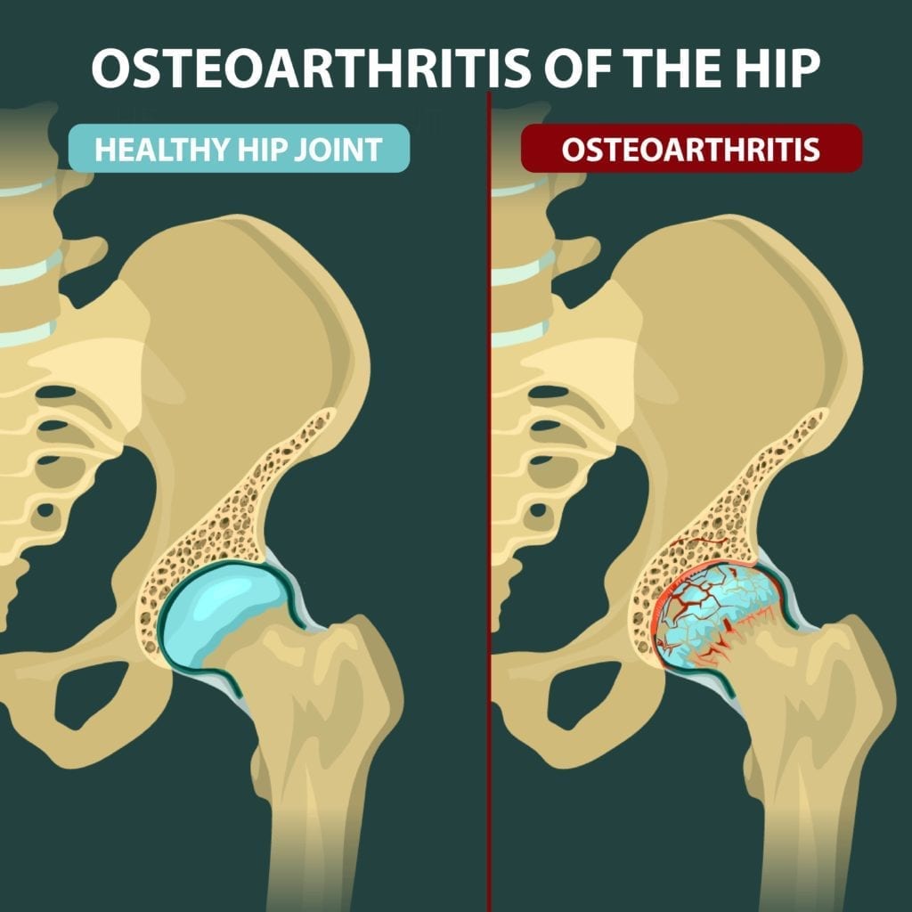 How quickly does hip osteoarthritis progress?