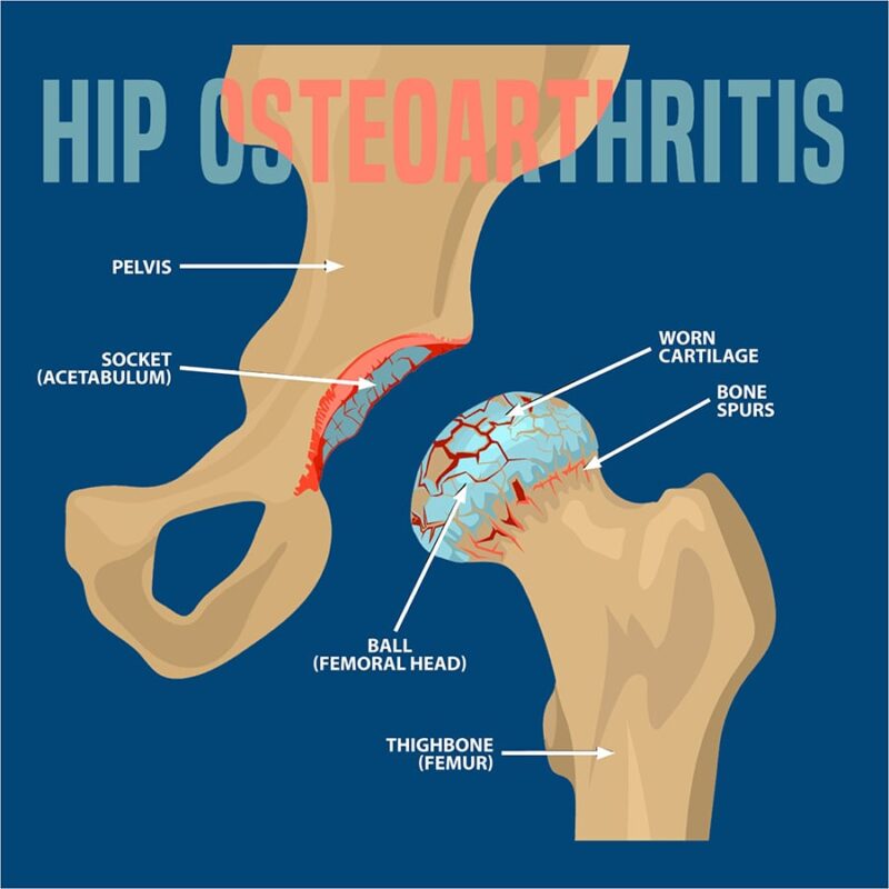 Osteoarthritis Of The Hip Florida Orthopaedic Institute 5295