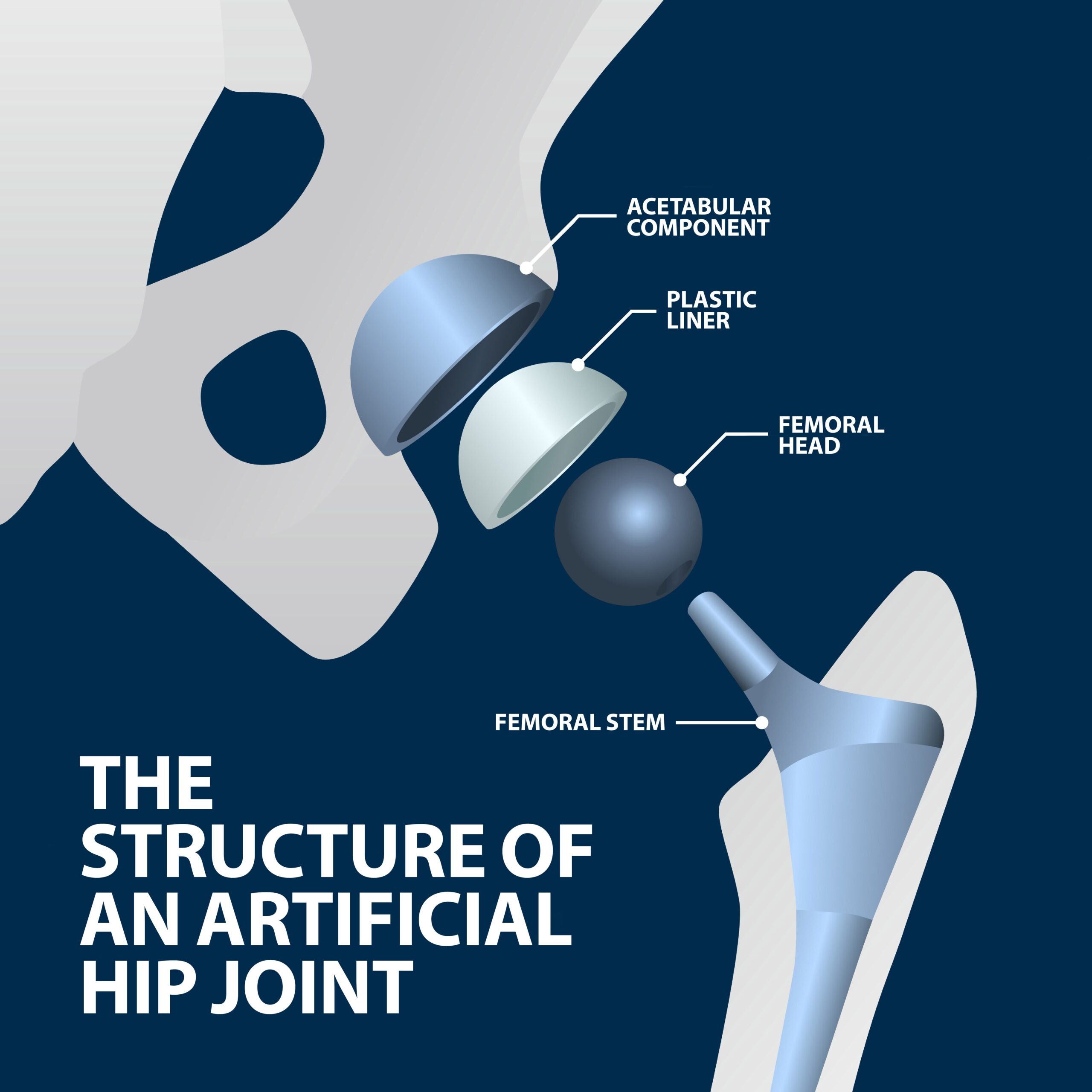 Anterior Approach for Hip Replacement - Connecticut Orthopaedics