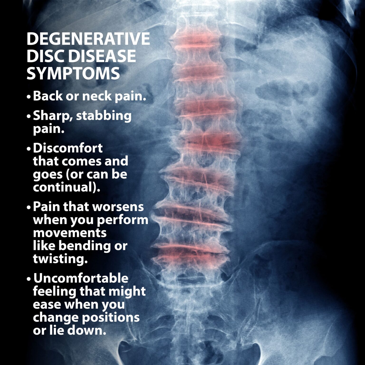 What Is A Degenerative Disc Disease Ddd Hot Sex Picture 0035