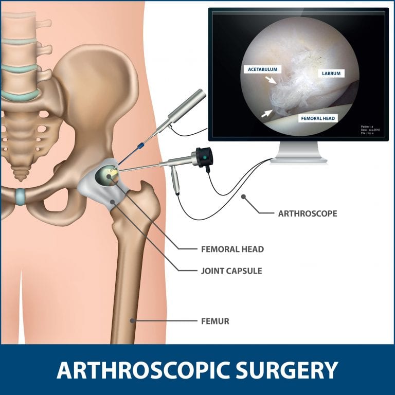 Hip Impingement Labral Tears Florida Orthopaedic Institute 