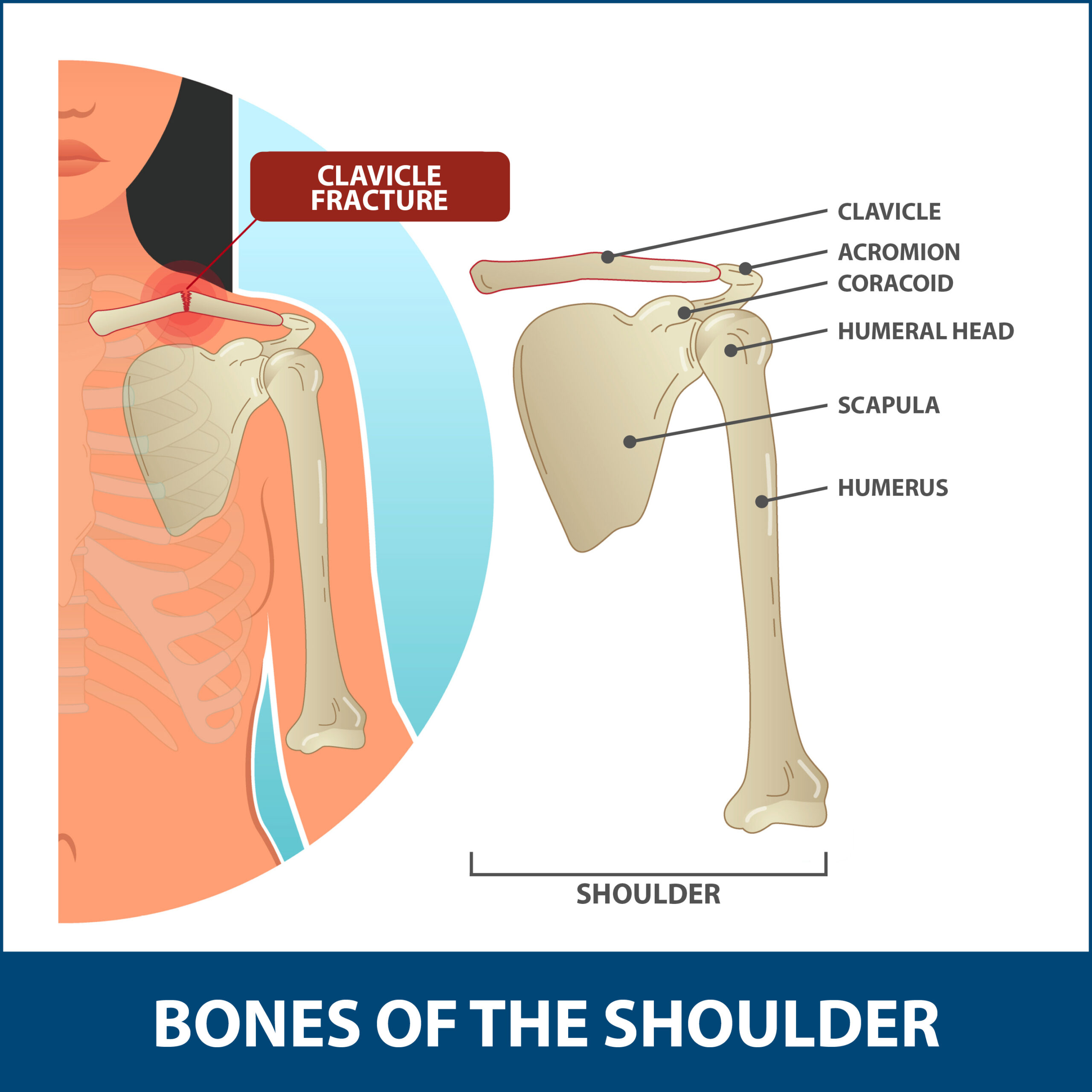 What nerve is injured in medial clavicle fracture?
