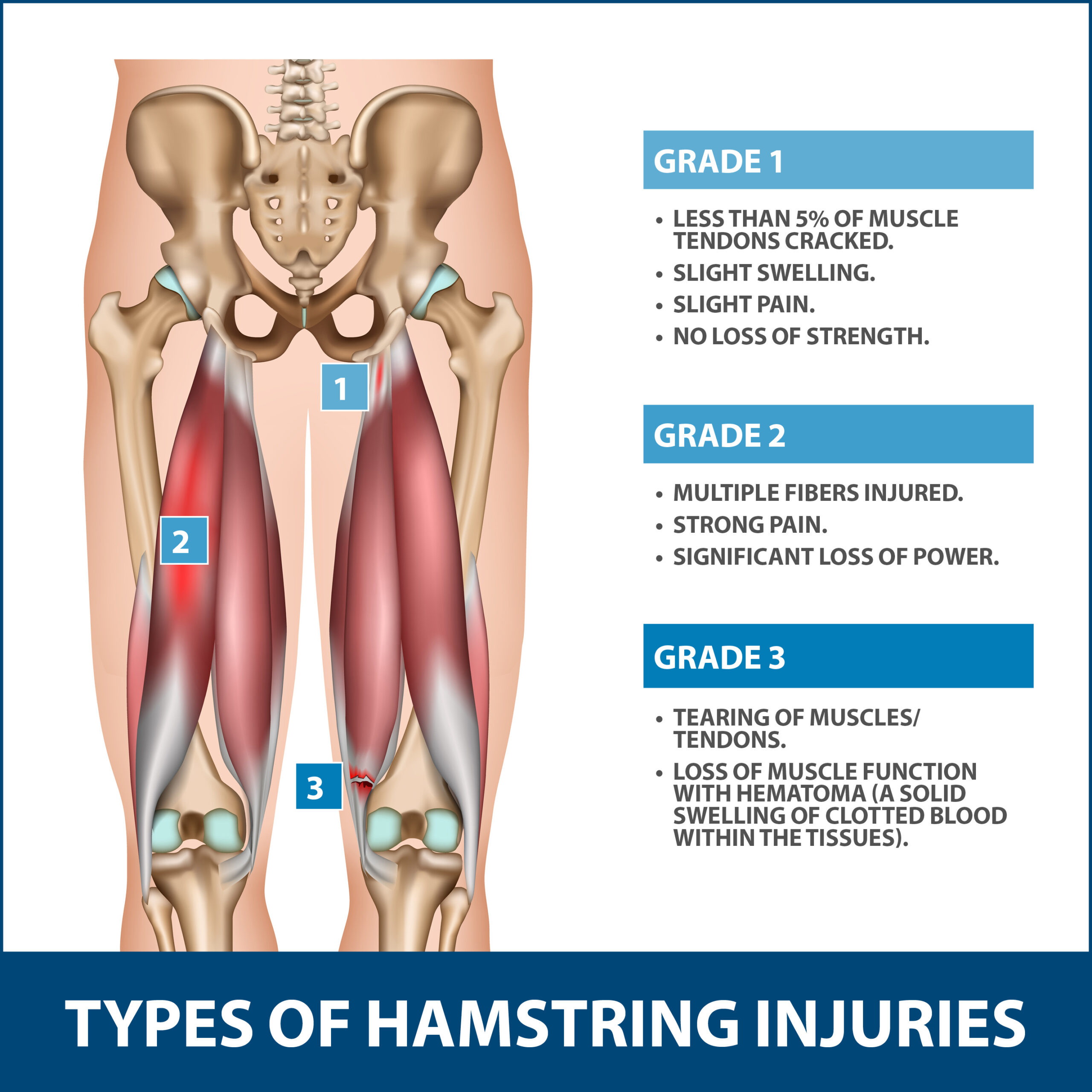 Hamstring injuries - powerful and painful, will they heal on their