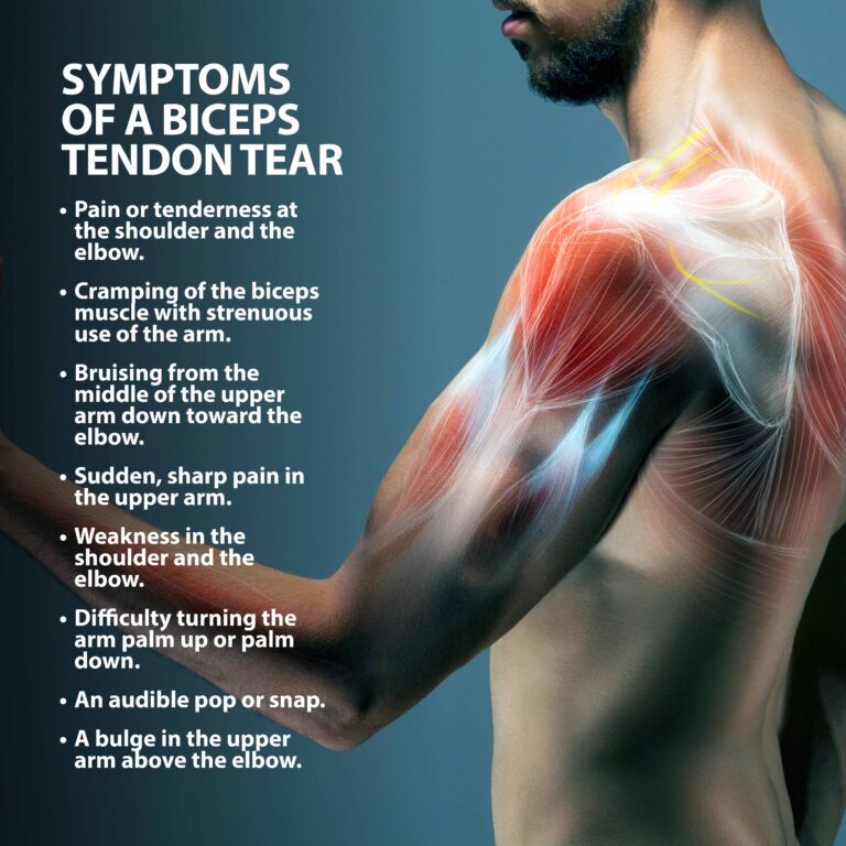 Bicep Tendon Tear Info Florida Orthopaedic Institute 4779