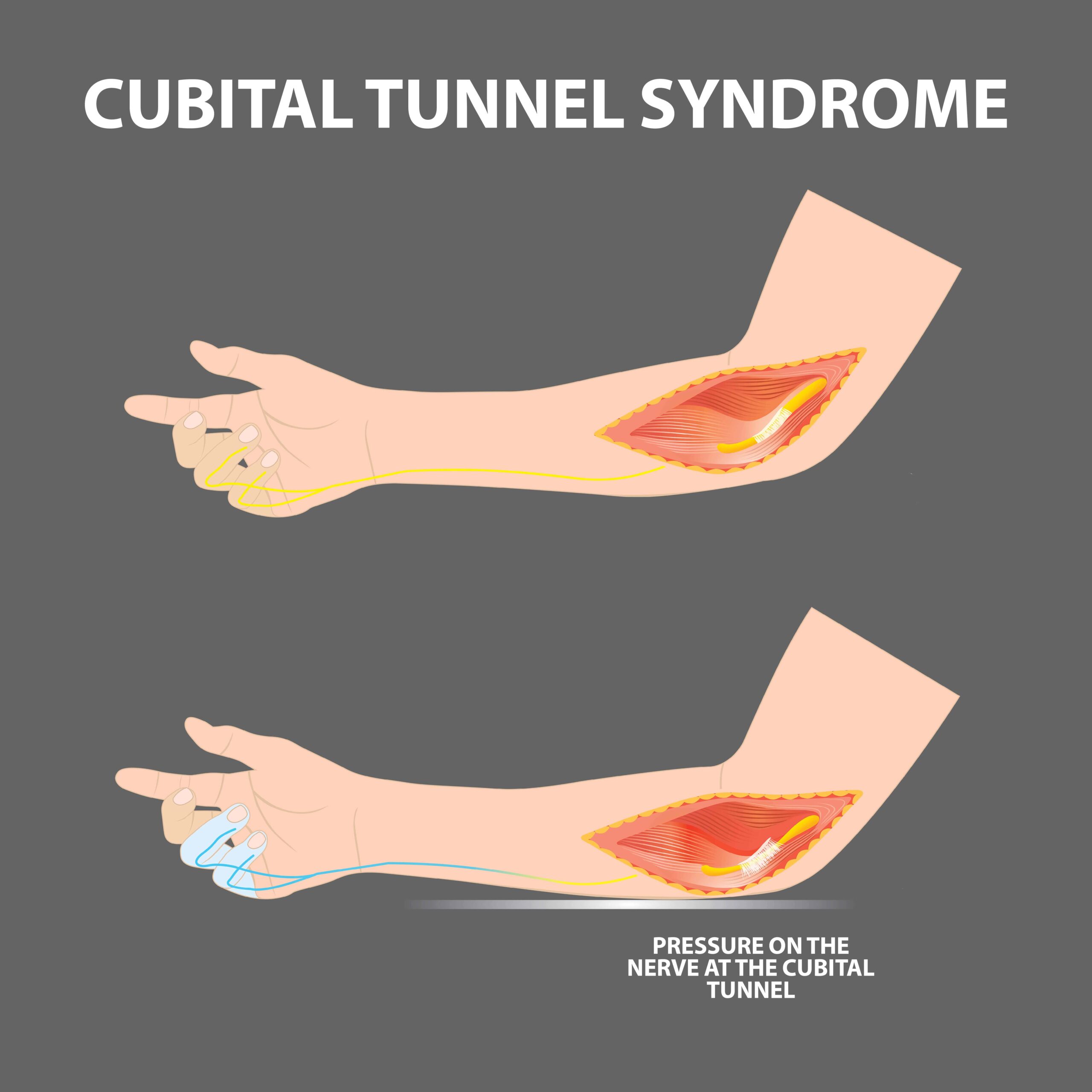 Cubital Tunnel Syndrome – Carolyn Yang, MD
