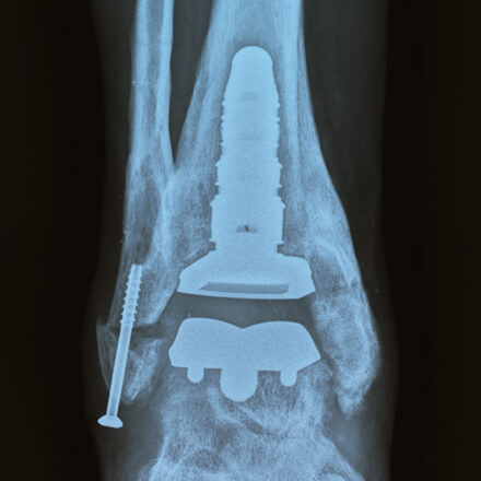 x-ray showing ankle joint from foot and ankle specialists