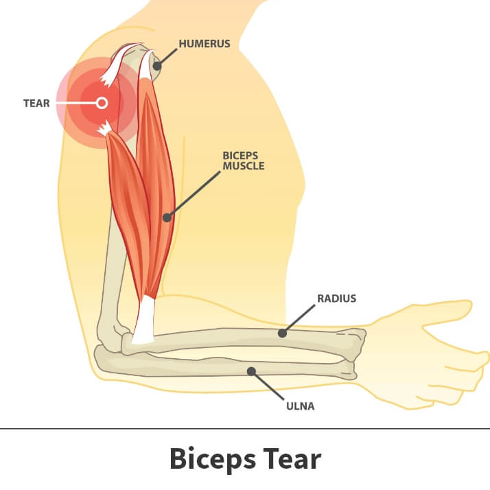 Biceps tenodesis diagram