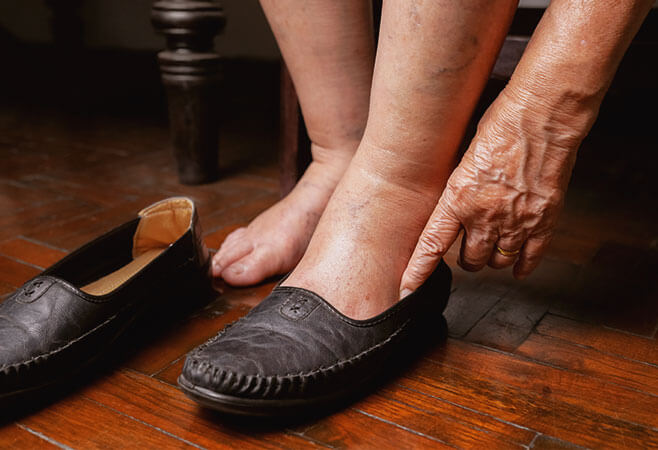 Elderly woman with charcot foot disease (neuropathic arthropathy) putting on shoes