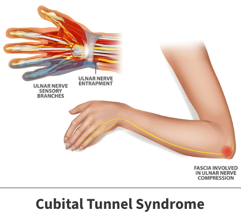 Cubital tunnel syndrome diagram