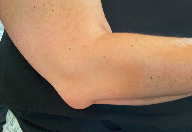 Woman with elbow bursitis