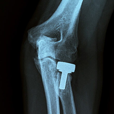 x-ray showing elbow joint