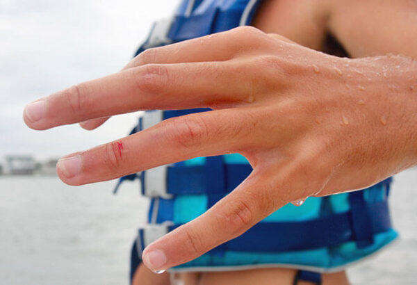 Dislocated Finger | Florida Orthopaedic Institute