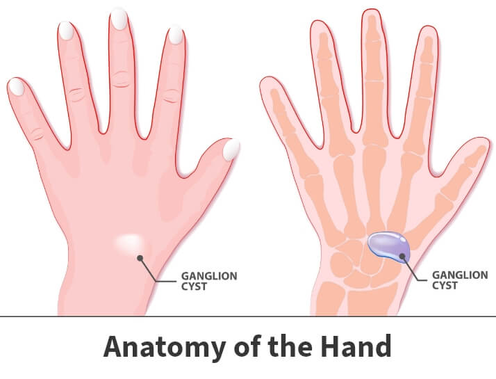 Anatomy of the hand showing wrist ganglion cyst