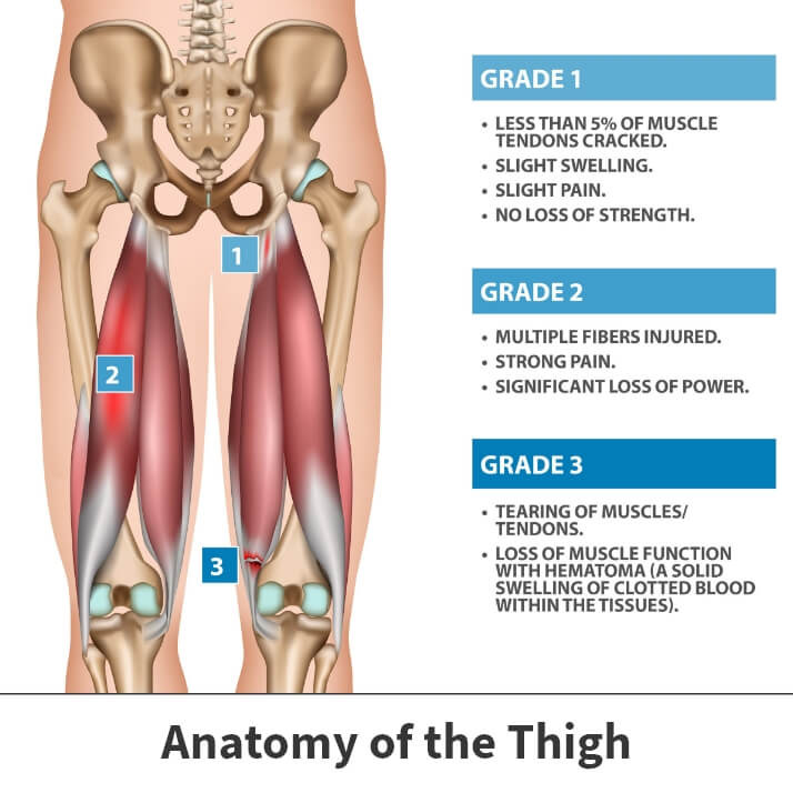 Types of hamstring injuries diagram