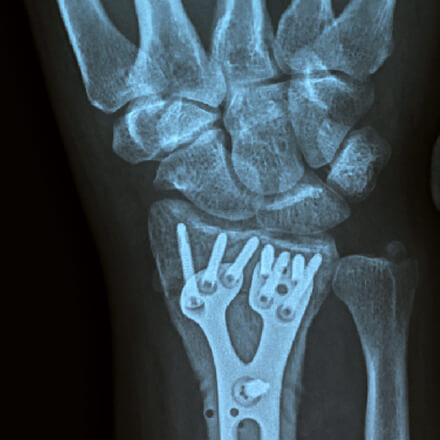 x-ray showing wrist joint