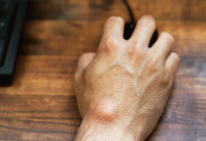 Ganglion cyst on man's hand while holding computer mouse