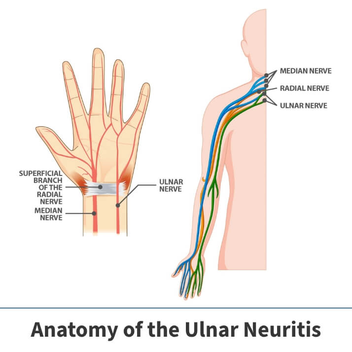 Anatomy of the ulnar neuritis or cubital tunnel syndrome