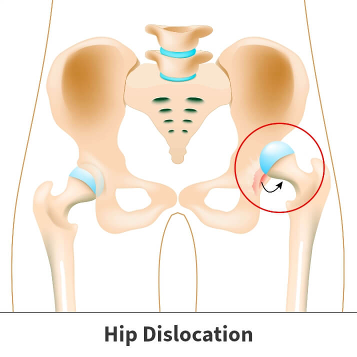 Hip dysplasia (dislocated hip) diagram