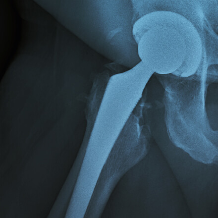 x-ray showing hip joint