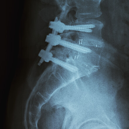 x-ray showing screws in spine