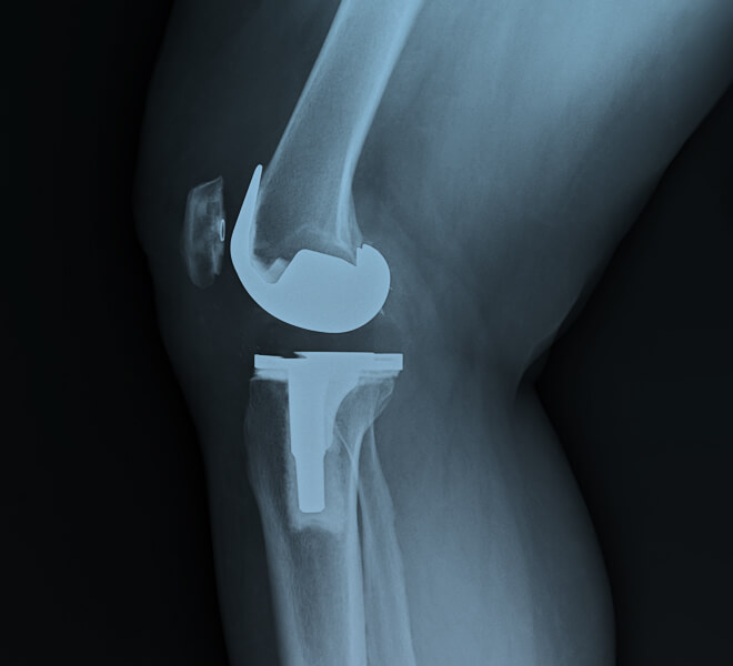 knee joint x-ray after joint replacement surgery