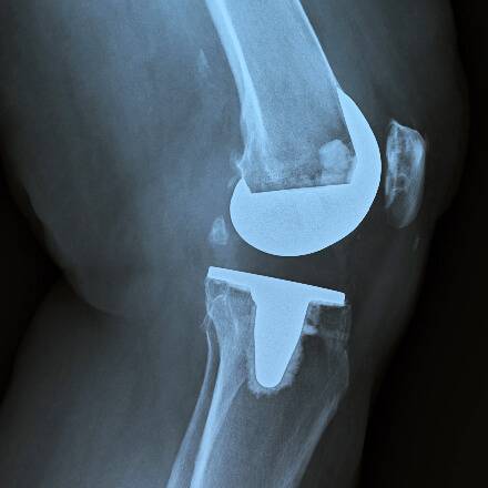 x-ray showing knee joint