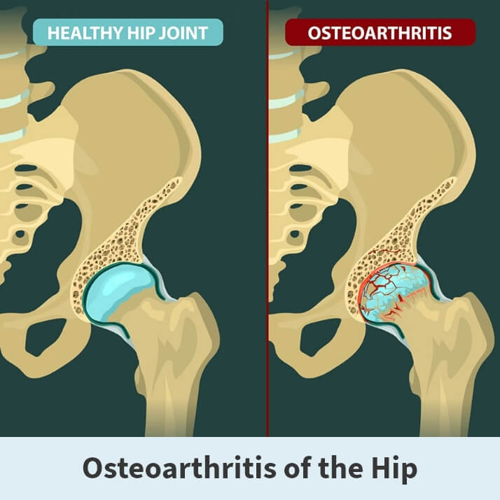 Osteoarthritis of the hip