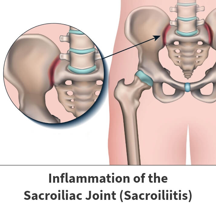 Inflammation of the sacroiliac joint (sacroiliitis) diagram