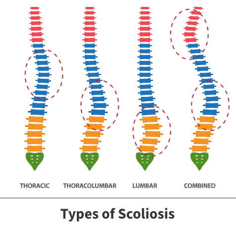 Types of scoliosis