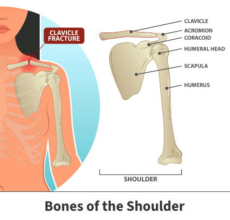 Anatomy of the shoulder, clavicle fracture