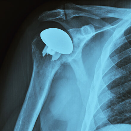 x-ray showing shoulder