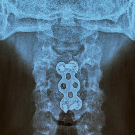 x-ray showing spine taken by spine specialists