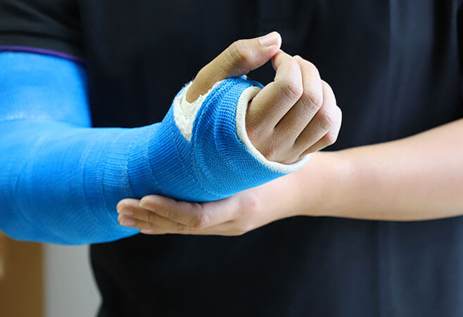 Closeup of man's arm with long arm cast for broken wrist