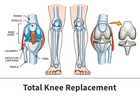 Total knee replacement